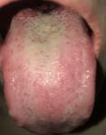 Воспаление полости рта фото 2