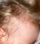 Аллергия на лбу у ребёнка фото 2