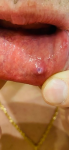 Болячка на внутренней стороне губы фото 1