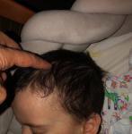 Шишка костяная на голове у ребёнка фото 1
