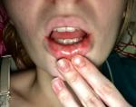 Красные пятна внутри губ. Аллергия фото 1