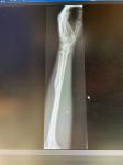 Боль костей и суставов руки после перелома фото 2