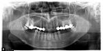 Боль в зубе под коронкой фото 1