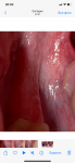 Слизистая рта после операции фото 4