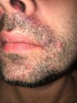Воспаления кожи в области усов и подбородка фото 1