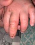Гнойнички на пальцах у ребёнка фото 2