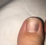 Темное пятно на пальце ноги фото 1
