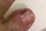 Гноящаяся рана на пальце ноги фото 1