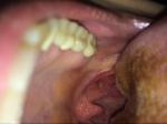 Ком в горле, миндалины, лимфоузлы фото 4