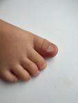 Расслоение ногтей ребенок 1 год, пятна на ступнях фото 1