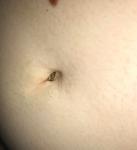 Образование в пупке фото 2