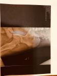 Перелом передне нижней подвздошной кости фото 2