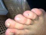 Пятно на ногте пальца ноги меланома или гематома? фото 3