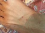 Появился дерматит на теле, больше всего высыпаний на ногах фото 2