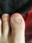 Повреждение ногтя ноги фото 2