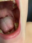 Новый зуб у ребёнка фото 1