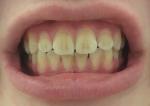 Полосы на зубах фото 1