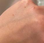 Появление «водяных прыщиков» на руке под кожей фото 1