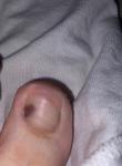 Пятно на большом пальце на ногте (нога) фото 1