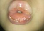 Болячки на губах у ребенка фото 1