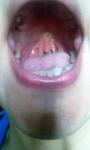 Осложнённый фарингит после удаления зуба с левой стороны фото 4