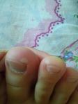 Псевдомозоли на пальцах ног фото 2