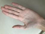 Плотная шишка на вене руки (ладонь), болит при надавливании фото 2
