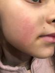 Аллергия на пыль или шерсть фото 1
