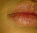 Болячки на губах фото 1