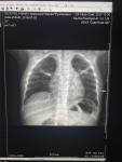 Пневмония у ребёнка 2 лет фото 1