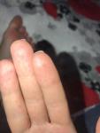 Красная сыпь на мочках пальцах рук и ног фото 4