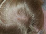 Зудящие прыщи на голове с выпадением волос фото 2