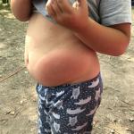 Аллергия у ребёнка на укусы насекомых фото 1