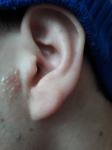 Маленький красные пупырышки в наружной части левого уха фото 1