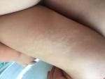 Высыпание на коже у ребёнка 3 года фото 2