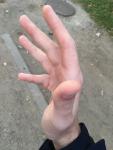 Дефект руки после травмы фото 2