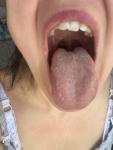 Глоссит, аллергия или воспаление языка фото 2