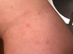 Высыпания в виде укусов комаров на талии, голенях и предплечиях фото 2