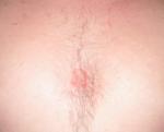 Красное пятно в центре грудной клетки фото 1