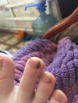 Потемнение ногтя на пальце на ноге фото 1