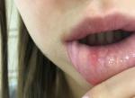 Воспаление бахромчатой складки и травмирование губы фото 2