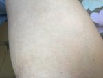 Недостаток и неравномерное распределение меланина - белые пятна на коже фото 3