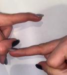 Палец кривой после перелома фото 4
