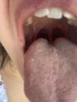 Глоссит, аллергия или воспаление языка фото 1