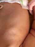 Сыпь у новорожденного, 1 месяц фото 1