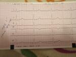 Помогите по результату ЭКГ фото 1