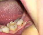 Почернение зуба у взрослого фото 1