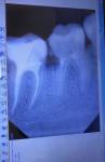 Удаление зуба или вкладка и лечение фото 1