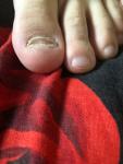 Повреждение ногтя ноги фото 1