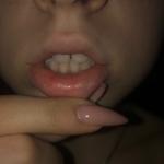 Красные пятна на слизистой губы фото 1